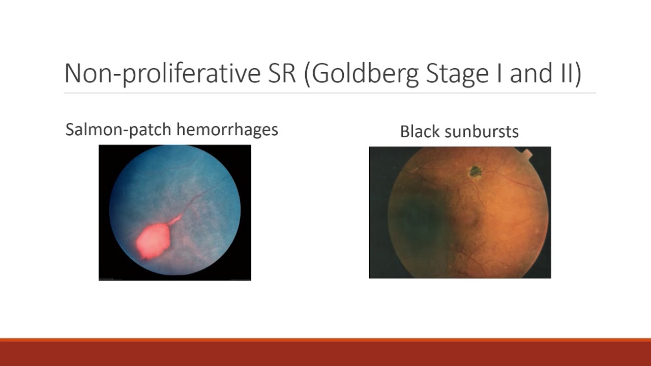 scleral icterus and sickle cell anemia